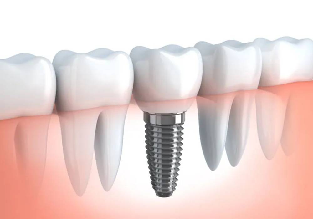 The Ultimate Guide to Dental Implants: Everything You Need to&nbsp;Know